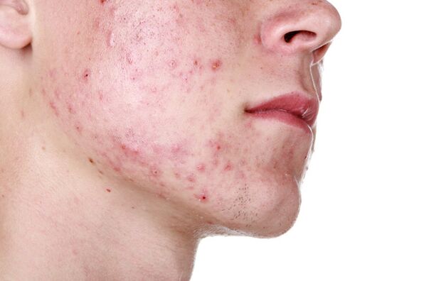 Facial skin damaged with demodicosis